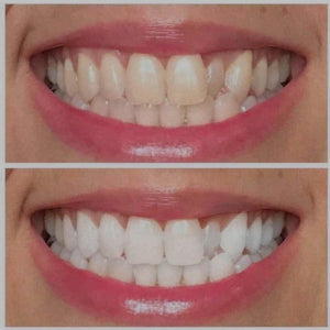 Ultraviolet Pearly White Teeth Whitening Gel